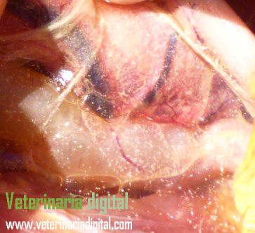 Visceral gout on peritoneum