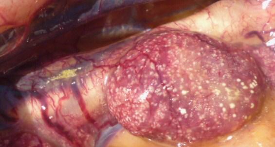 Kidney visceral gout