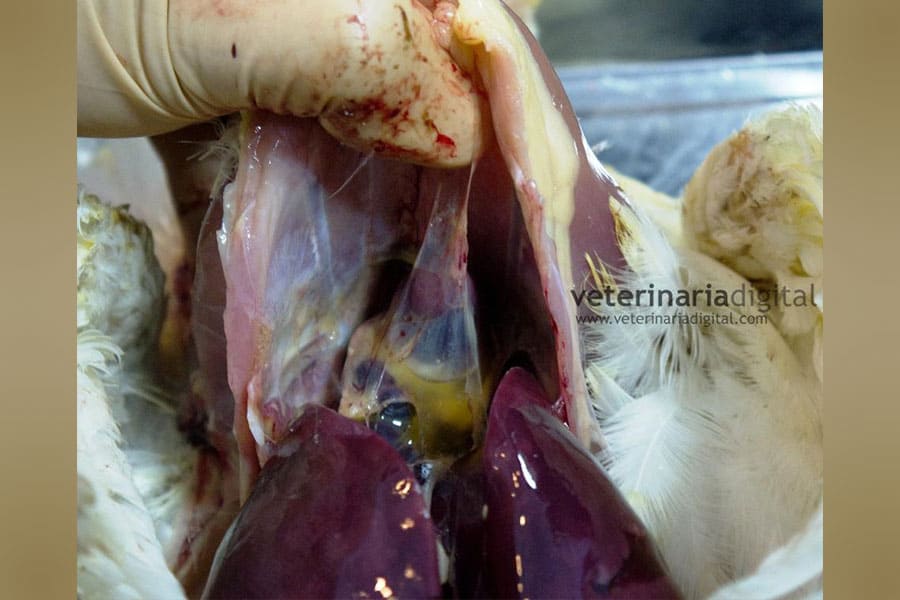 Hydrosis in Pericardium
