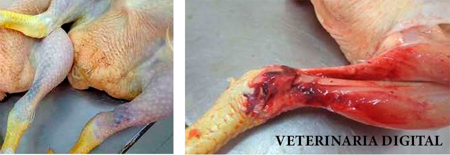 Lesion of the gastrocnemius